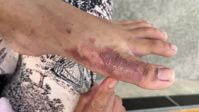Severe second degree burn wound on top foot area (instep), visible bullae on the surface