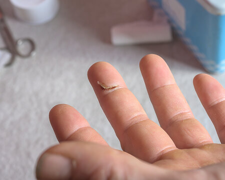 Close-up of an injured finger with a small cut and home first aid kit in the background. Concept of wound care and domestic treatment