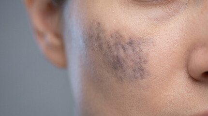 Naklejka premium Melasma Skin Condition Concept Showing Irregular Hyperpigmented Areas in a Clinical Stock Composition