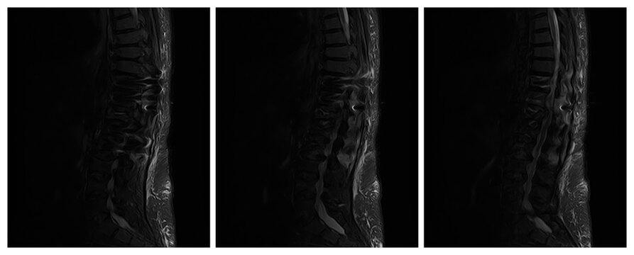 Postoperative Sagittal STIR MRI Series of Lumbar Spine with Fat Suppression