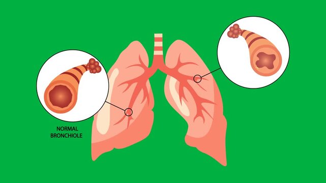 Medical vector animation illustrating asthma with narrowed and inflamed bronchioles, mucus buildup, and restricted airflow, highlighting bronchial hyperresponsiveness and related green background