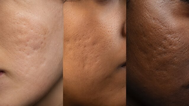 Rolling acne scar comparison across three diverse skin tones from light to dark, acne scarring on Fitzpatrick skin types II IV and VI