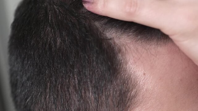 Extreme close-up of a man using his hand to pull back his hair and examine the temporal hairline and receding corners. Detailed view of the scalp and short dark hair representing male hair loss