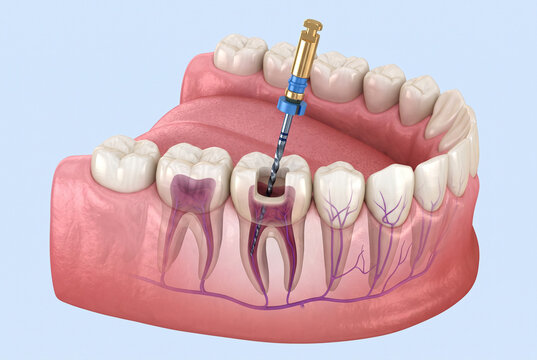 Detailed 3D Dental Root Canal Illustration for Patient Education