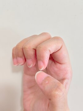 hangnail