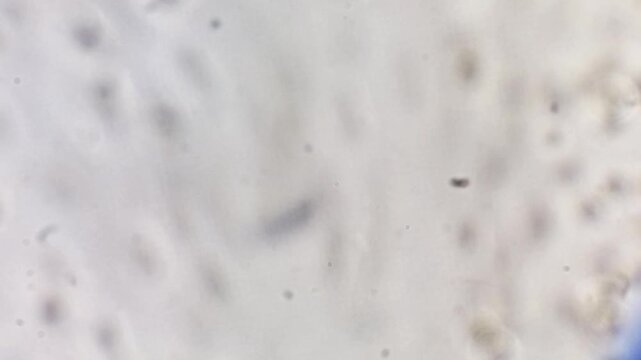 Microscopic footage of urinalysis showing plenty Red blood cells (RBC) and also bacteria. 