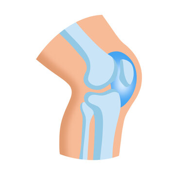 Patellar Bursitis Illustration