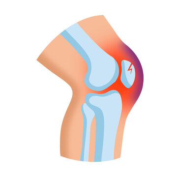 Pattelar Fracture With Bruising