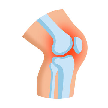 Arthritis Of The Knee