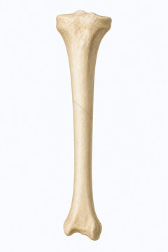 Hairline stress fracture in shin bone illustration