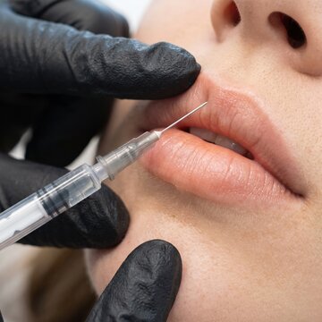 Close-up of a gloved specialist injecting dermal filler into a woman's lips during a lip augmentation procedure, cosmetic and beauty treatment.