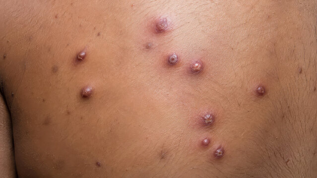 Mpox Skin Lesions at Different Stages, Clinical Dermatology and Infection Concept