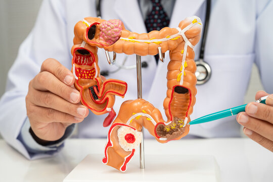 Colorectal cancer, doctor holding intestine colon human model.
