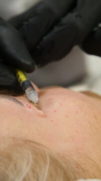 Professional cosmetologist making botox injection in female forehead close up. Doctor giving mesotherapy injections to patient face in beauty clinic - Vertical Video