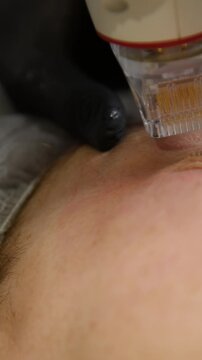 A multifunctional device for microneedle RF lifting. Aesthetic procedures for non-surgical lifting, smoothing fine lines, minimizing pores, regulating sebum production, and evening out skin texture.