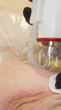 A multifunctional device for microneedle RF lifting. Aesthetic procedures for non-surgical lifting, smoothing fine lines, minimizing pores, regulating sebum production, and evening out skin texture.