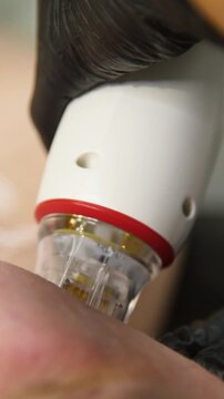 A multifunctional device for microneedle RF lifting. Aesthetic procedures for non-surgical lifting, smoothing fine lines, minimizing pores, regulating sebum production, and evening out skin texture.
