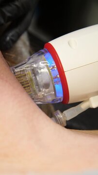 A multifunctional device for microneedle RF lifting. Aesthetic procedures for non-surgical lifting, smoothing fine lines, minimizing pores, regulating sebum production, and evening out skin texture.