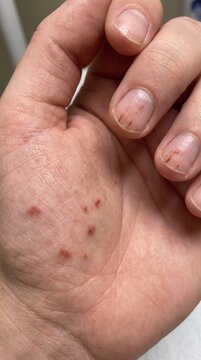 Vertical close-up of human hand showing palmar skin lesions and splinter hemorrhages in fingernails
