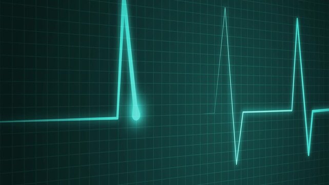 Ecg heart rhythm line on graph paper showing pulse spikes and flat line animation