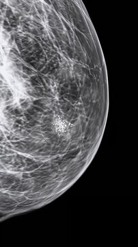 Mammogram shows suspicious breast lesion. Cancer screening and early detection for healthcare with copy space