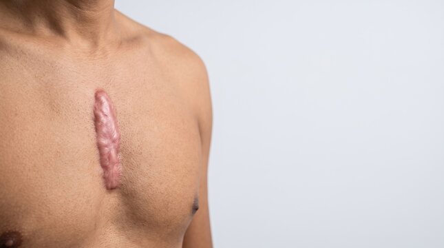 Severe vertical raised keloid scar on male chest after open heart sternotomy surgery