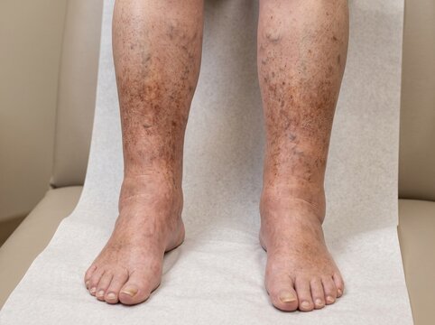 Bilateral Chronic Venous Edema and Stasis Skin Changes in Elderly Legs