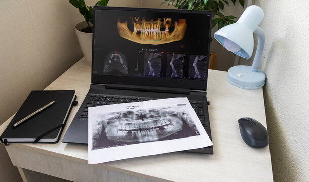 Laptop Displaying Dental 3D CBCT Tomography Software with Printed Jaw Panoramic X-Ray on Keyboard. Dental