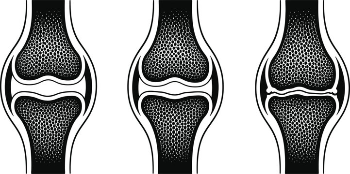 Human Joint Cross Section Cartilage Bone Medical Vector Illustration