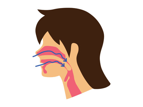 OSA and Complete Obstruction of the Airway during Sleep