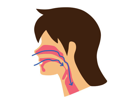 Snoring and Partial Obstruction of the Airway during Sleep