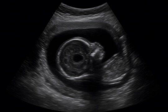 Fetal heartbeat ultrasound. Prenatal sonogram imaging. Realistic grayscale medical scan. Pregnancy