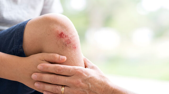 Adult comforting child with scraped knee injury.