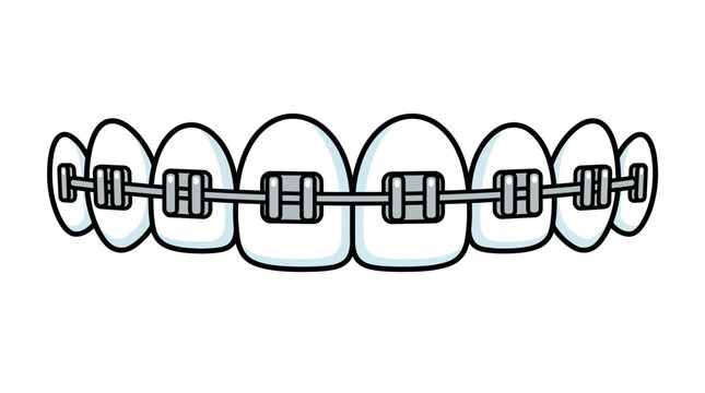 Cartoon illustration of human teeth with metal dental braces for orthodontic treatment and alignment.