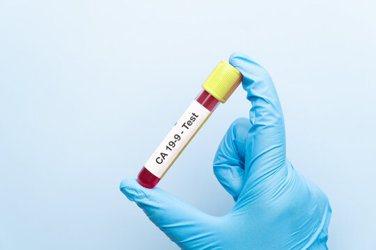 Doctor holding a test blood sample tube with CA 19-9 test, tumor marker for pancreatic and stomach cancers.