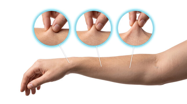 Ehlers Danlos syndrome joint hypermobility flexible arm, medical concept showing abnormal joint flexibility and connective tissue disorder
