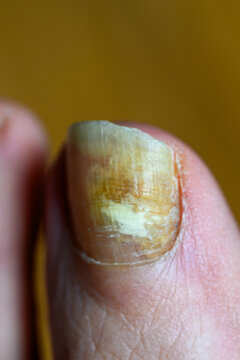 Yellowish nail shows signs of discoloration and thickening