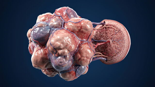 3D medical illustration of malignant skin tumor originating from eccrine sweat gland, annotated anatomical cross‑section