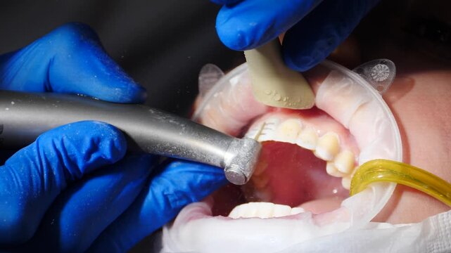 Dentist gloved hands precisely treating tooth surface using dental tools. Retractor holds mouth open with. Professional cosmetic aesthetic dentistry for perfect veneers 4k