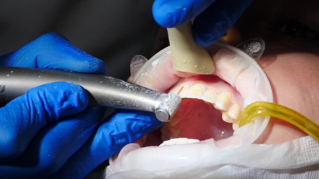 Dentist gloved hands processing tooth surface with metal instrument before veneer installation. Retractor holds mouth open, suction tube nearby. Precise cosmetic dental procedure 4k video