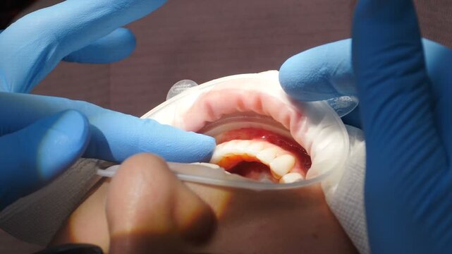 Dentist gloved hands fitting white dental veneers and crowns into patient mouth. Professional cosmetic restoration procedure ensuring perfect smile, dental aesthetics, and healthy teeth alignment 4k