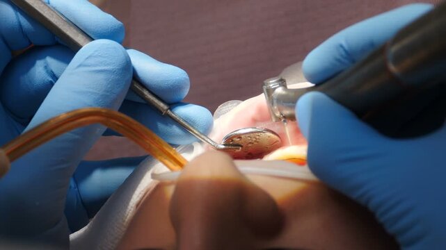 Close-up of dentist gloved hands treating tooth surface with metal instrument and curing light. Professional preparation for veneer installation, precise dental procedure for perfect smile 4k video