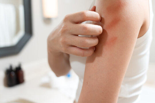 skin problem and beauty. Young woman scratch body has itchy skin from skin allergic, steroid allergy, sensitive skin, red from sunburn, chemical allergy, rash, insect bites, Seborrheic Dermatitis.