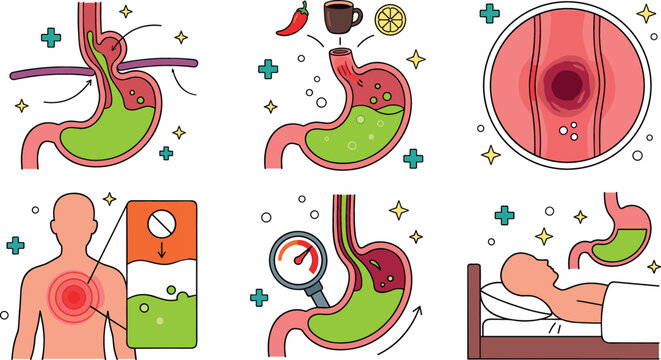 Gastroesophageal reflux disease GERD medical infographic vector set featuring stomach acid reflux hiatal hernia chest heartburn pain causes triggers and treatment icons