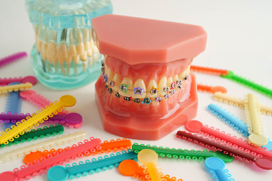 Orthodontic ligatures rings and ties, elastic rubber bands on orthodontic braces, model for dentist studying about dentistry.