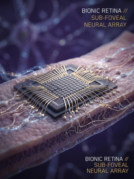 Prosthetic Bionic Retinal Microchip Interfacing With Neural Tissue
