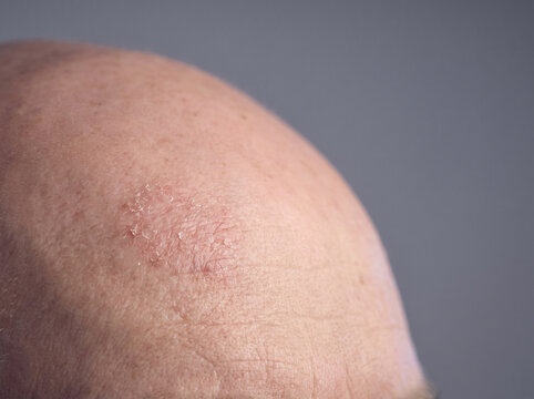 Close up macro of a bald scalp with a dry flaky skin patch and mild irritation on a neutral background creating a clinical dermatology concept