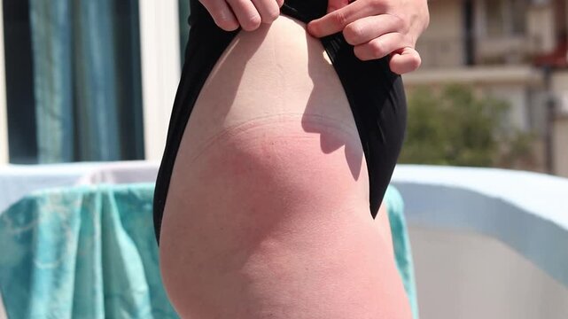 Close-up of a girl's skin in a black swimsuit with a clear tan line and pronounced redness from the sun. A woman shows a sunburn on her thigh. The consequences of tanning without sunscreen