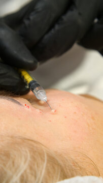 Injections of skin-lifting treatments. Mesotherapy. Close-up of female face during youth restoration and facial rejuvenation procedure.