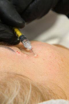 Injections of skin-lifting treatments. Mesotherapy. Close-up of female face during youth restoration and facial rejuvenation procedure.
